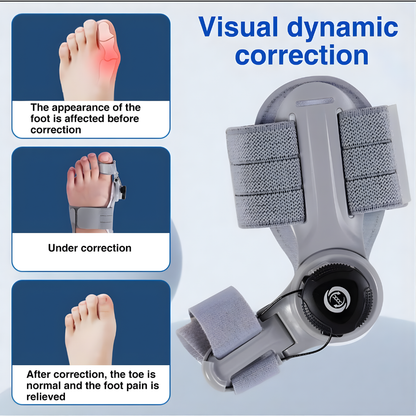 Handeelife™ Bunion Fix – Non-Surgical Bunion Corrector (Clinically Proven)